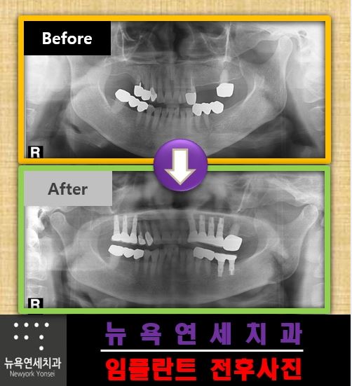 치아가 없어서 임플란트 수술을 받아야 한다면 치과 선택을 어떻게?
