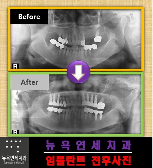  치아가 없어서 임플란트 수술을 받아야 한다면 치과 선택을 어떻게?