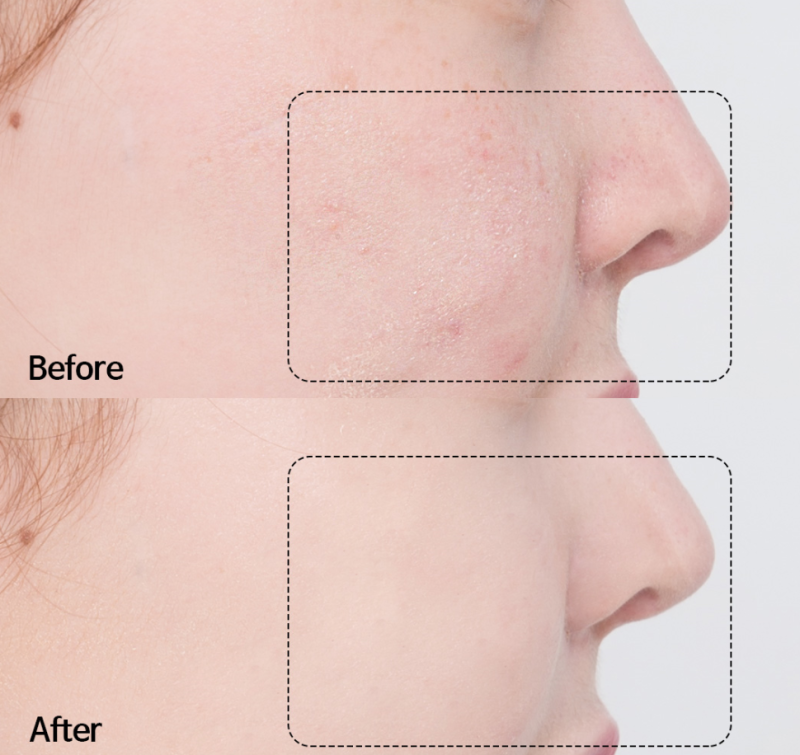 여드름없애는법 알려드릴께요! 3