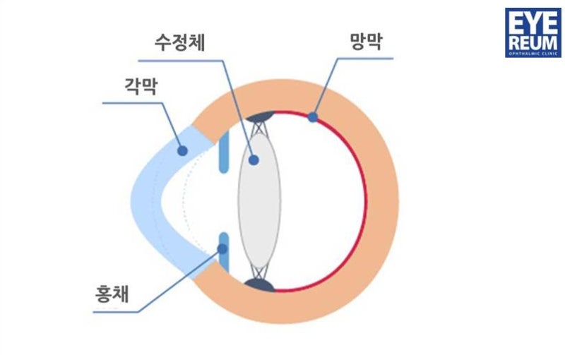 [원추각막] 시력교정술 전 정밀검사로 안전을 잡으세요!