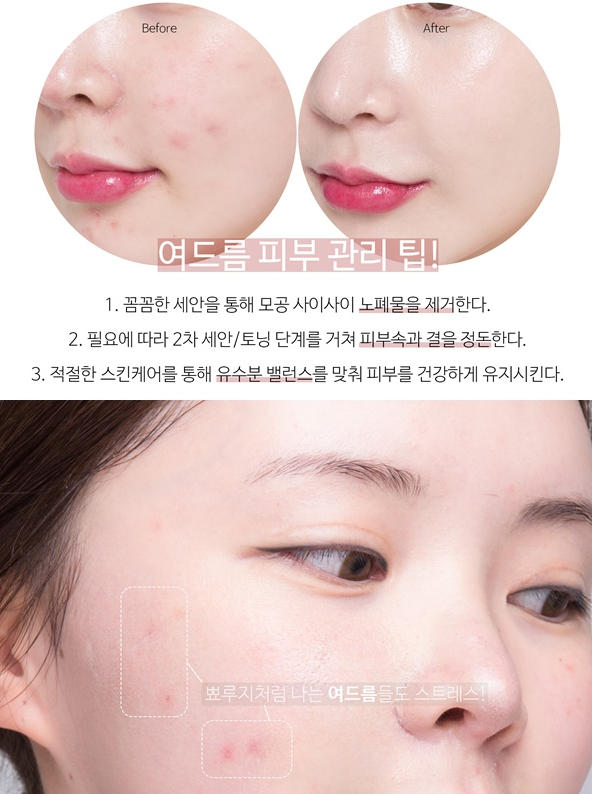 여드름없애는법 알려드릴께요!