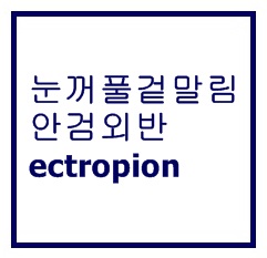  하안검 성형술 후 눈꺼풀 겉말림 (ectropion)