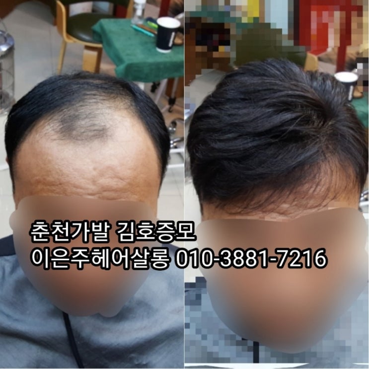  춘천가발 김호증모 남자맞춤가발 군인가발 고정식가발  관리받는날~^^