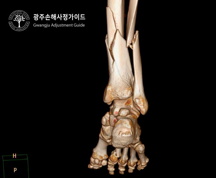 [광주 손해사정] 발목골절 후유장해에 대한 보험금 보상받기!! :: 광주손해사정 가이드 장한서