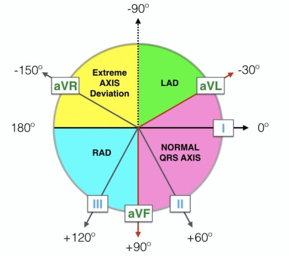  ekg left axis deviation lad right axis deviation
