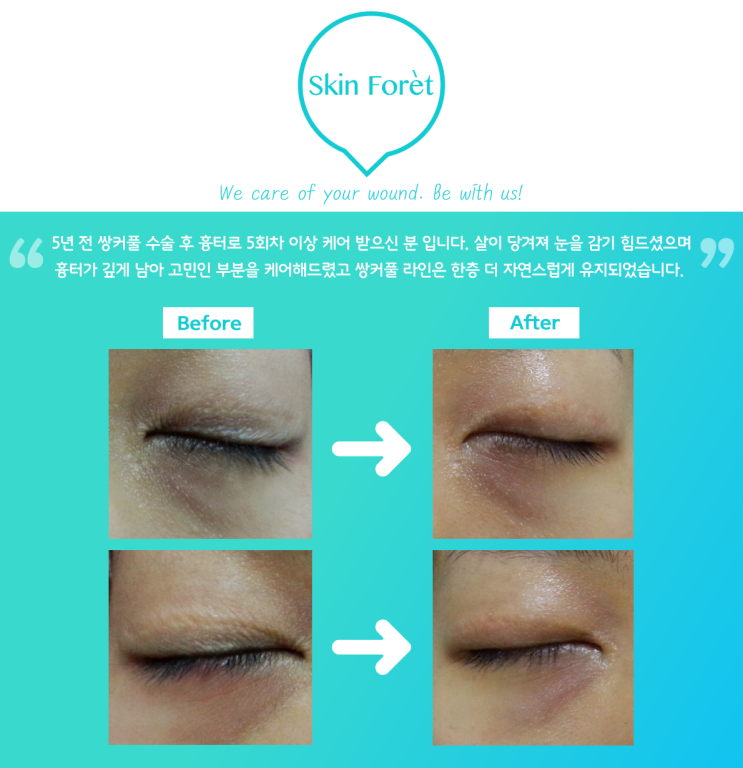  5년된 쌍커풀 흉터 케어 모습 *스킨포레 리얼 스토리*