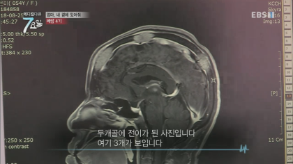 엔젤만 증후군을 앓고 있는 성인