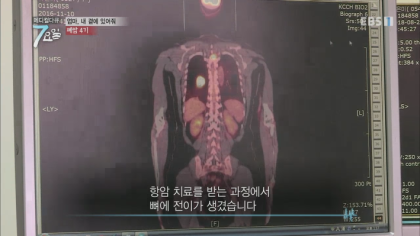 엔젤만 증후군을 앓고 있는 성인