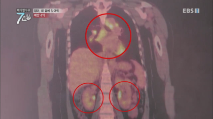 엔젤만 증후군을 앓고 있는 성인