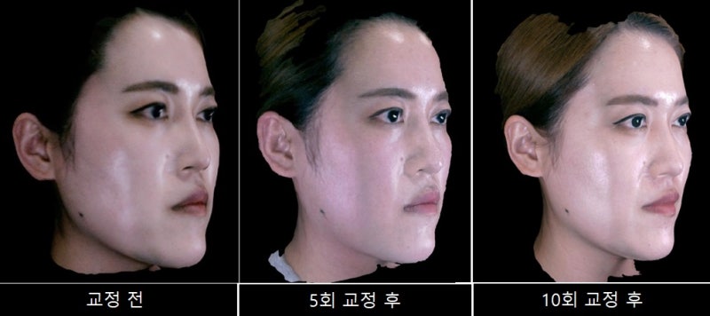 자가 교정 교정을 통한 얼굴 변화 4