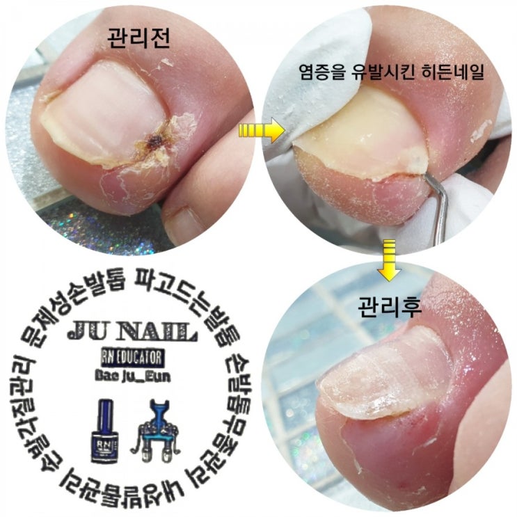 발톱염증때문에너무아파요/분당용인수원수지보정동백죽전동/주네일/파고드는발톱전문네일샵