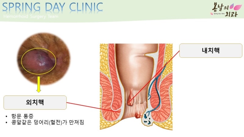 외침핵 가려움이란? 원인과 증상을 조사하다