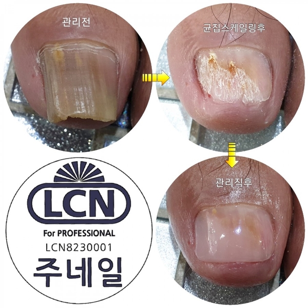 발톱이이렇게변한게10년도넘었어요./분당용인수원수지보정동백죽전동/주네일/무좀관리전문네일샵 발톱이이렇게변한게10년도넘었어요./분당용인수원수지보정동백죽전동/주네일/무좀관리전문네일샵