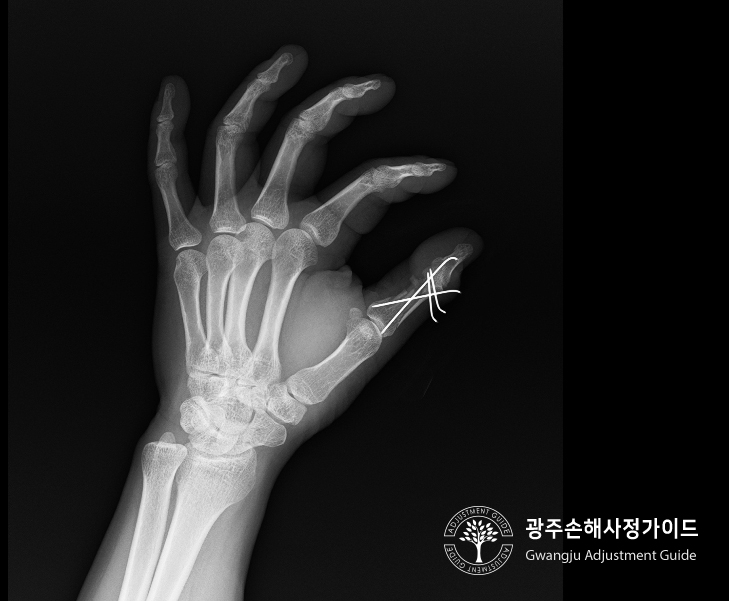 [광주손해사정] 손가락골절 후유장해 보험금수령 사례 :: 광주손해사정가이드 장한서