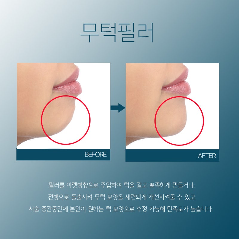 입술필러+무턱필러 자갈턱 보톡스 리뷰 팁 및 전후비교사진 5