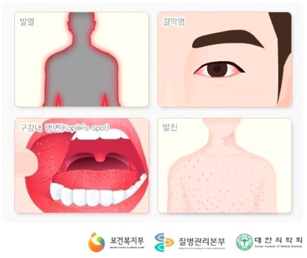 풍진 바이러스 검사와 합병증 - 폐렴, 수막염, 뇌수막염 : 네이버 블로그