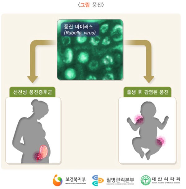 풍진 증상의 전염력 잠복기 예방접종 주사, 임산부 풍진 주사, 임신 초기 감염 위험성 4