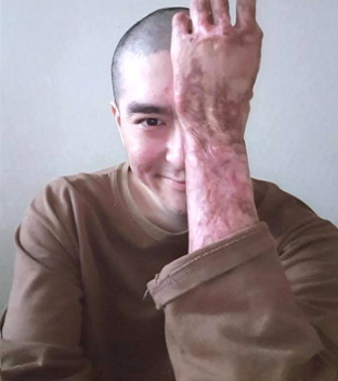  'K-9 자주포 폭발' 이찬호 병장님 근황...' 흉터, 상처 극복한 증거