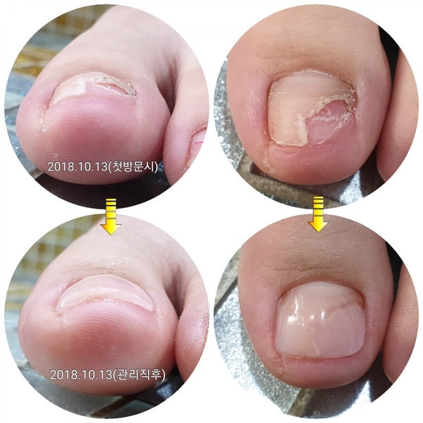 붙이는네일스티커사용후발톱이변했어요/분당용인수원수지보정동백죽전동/주네일/파고드는발톱전문네일샵 붙이는네일스티커사용후발톱이변했어요/분당용인수원수지보정동백죽전동/주네일/파고드는발톱전문네일샵