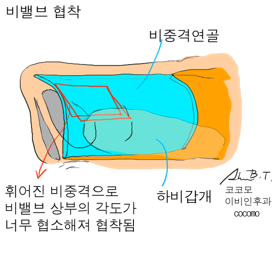  비중격만곡증수술후기 동영상을 통해 한눈에 이해해보자