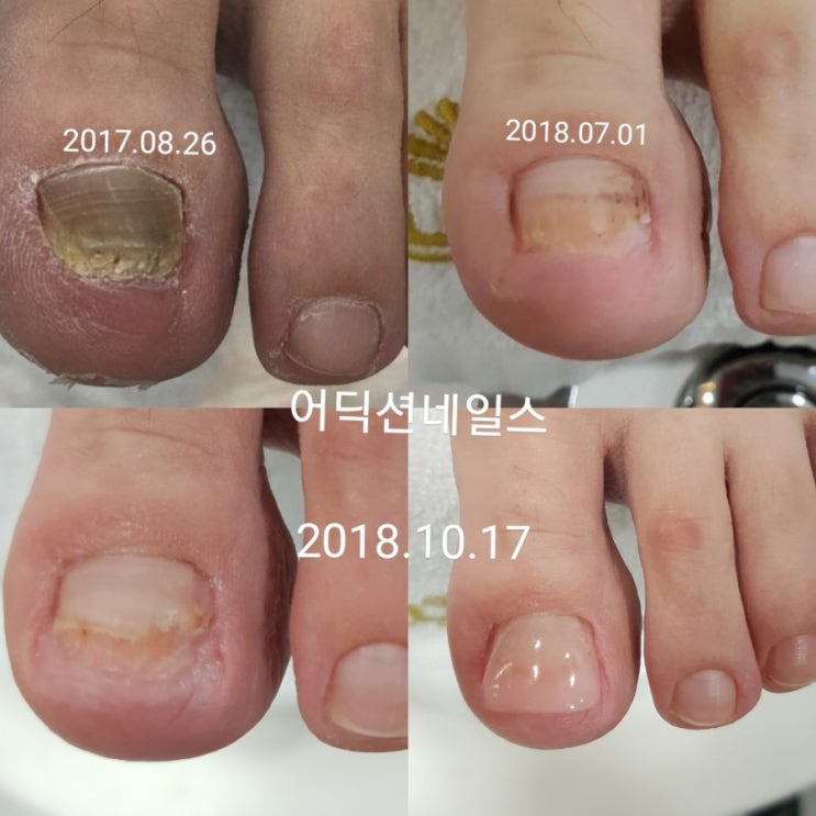  발톱무좀패디큐어