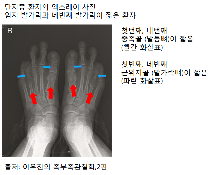 단지증. 짧은 발가락 : 엄지 발가락이 짧아요!, 네번째 발가락이 짧아요! 수술로 늘릴 수 있다구요? (족부 정형외과 전문의 ...