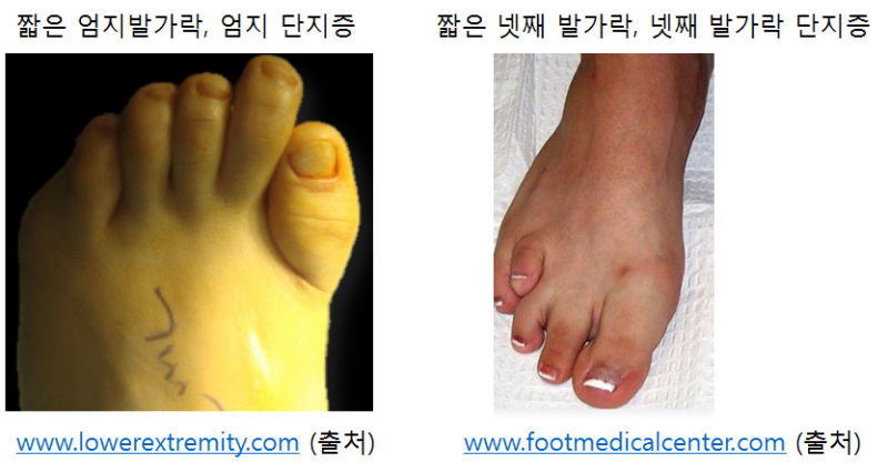 단지증. 짧은 발가락 : 엄지 발가락이 짧아요!, 네번째 발가락이 짧아요! 수술로 늘릴 수 있다구요? (족부 정형외과 전문의 ...