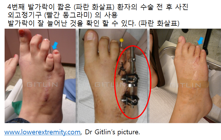 단지증. 짧은 발가락 : 엄지 발가락이 짧아요!, 네번째 발가락이 짧아요! 수술로 늘릴 수 있다구요? (족부 정형외과 전문의 ...
