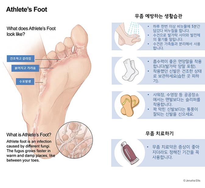 무좀 증상 예방법은 이제 지켜야 해요.