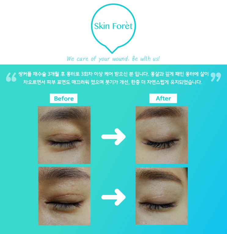  쌍꺼풀흉터피부 / 소세지눈 / 흉살 / 오래된흉터피부 / 빨갛고 짙은 쌍커풀 라인 케어