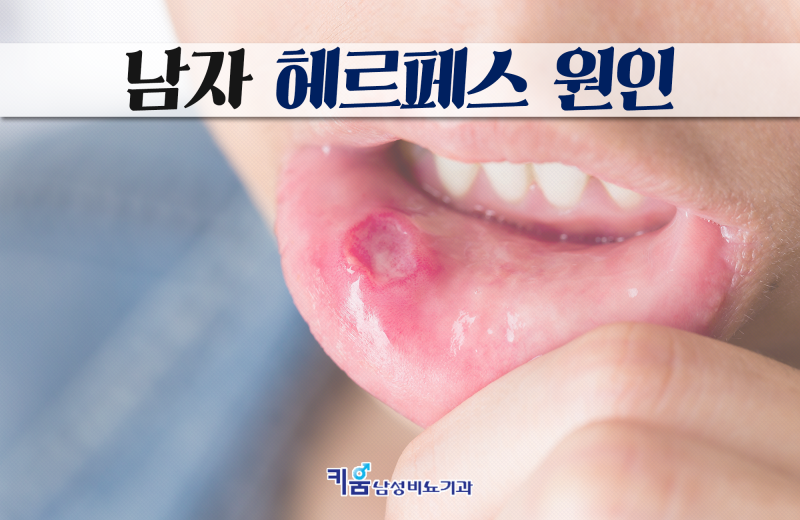 남자 헤르페스 증상 전염되기 전 3