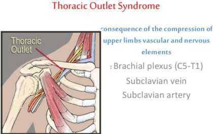 Vascular Thoracic Outlet Syndrome - ScienceDirect