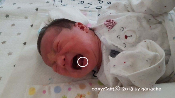  아기 설소대 수술, 인천정우식소아과 (생후 42일)