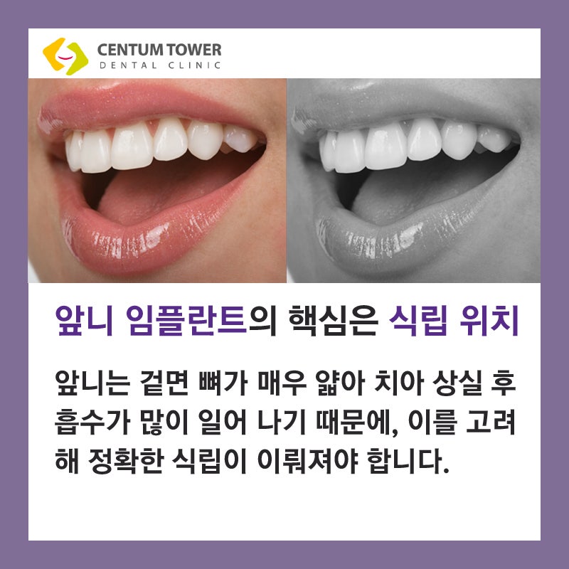 앞니 임플란트 개요