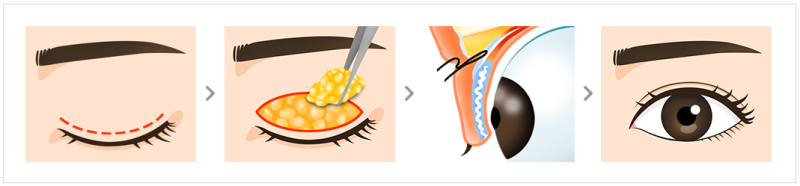 상안검, 하안검 잘하는 곳 추천!