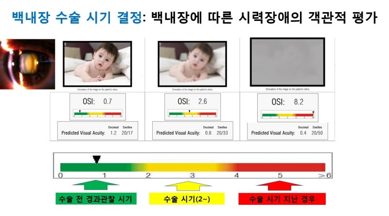 대구백내장수술 시기에 맞춰