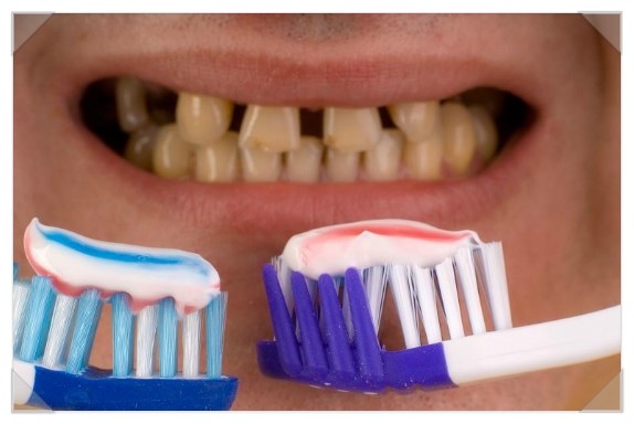 전문가 치아미백 종류 중에 나에게 맞는 치아미백 방법은?