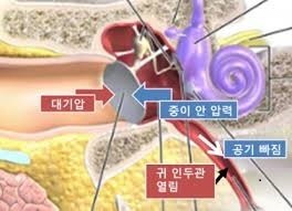  [창원,이명,난청] 귀가 먹먹해요 귀가 멍멍해요