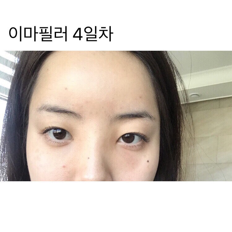 강남역 이마필러후기 6cc ( 미간붓기 / 통증 / 유지기간 / 관자필러 / 이마필러잘하는곳 / 1일~7일차 / 정보공유 ) 12