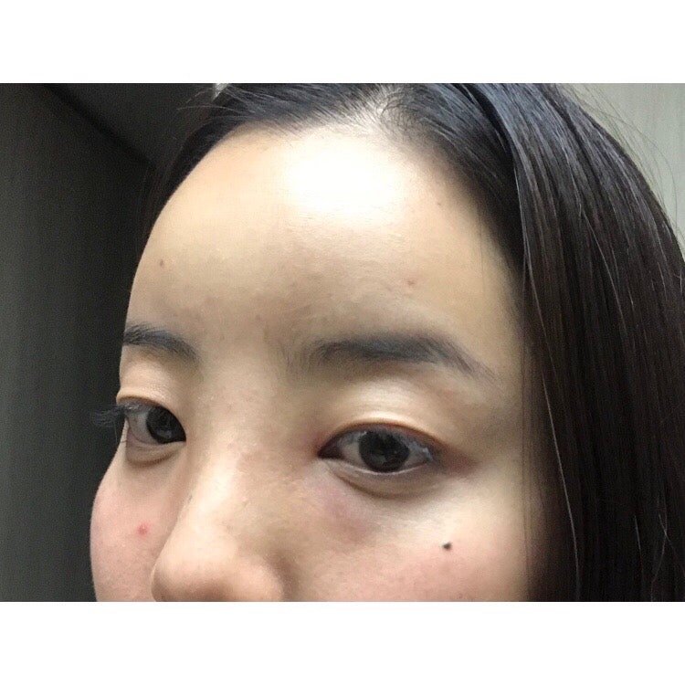 강남역 이마필러후기 6cc ( 미간붓기 / 통증 / 유지기간 / 관자필러 / 이마필러잘하는곳 / 1일~7일차 / 정보공유 ) 4