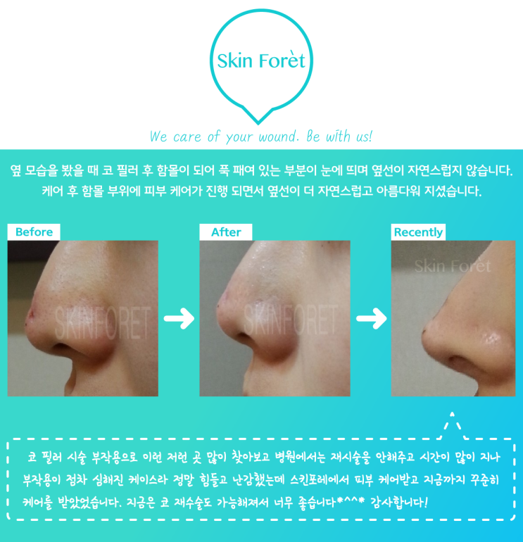  코 필러 함몰 흉터 피부 케어 / 코 시술 / 코 필러 후 / 성형 관리 / 후 관리 / 스킨포레 성형후케어 / 시술 후 케어