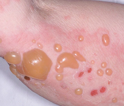 수포성 유사천포창(bullous pemphigoid, 물집유사 천포창, 유사물집증)