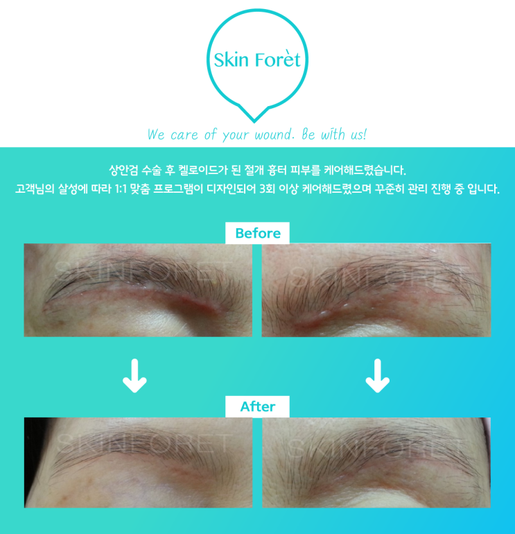  눈썹 거상 흉터 피부 / 켈로이드 / 흉터 피부 개선 / 수술 후 티안나게 / 눈매교정 / 눈커풀 올리는 / 또렷한 눈동자 / 맞춤프로그램 / 상안검 수술 후 흉터