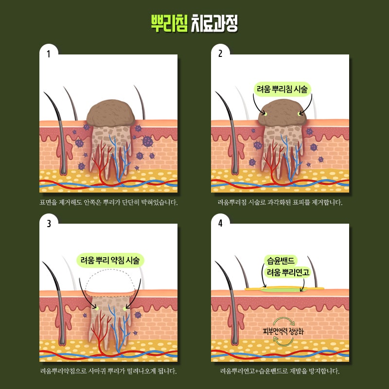 편평사마귀연고깨끗한얼굴관리과정