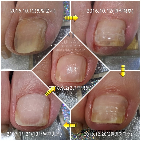 청주 오창에서 오셨던 파고드는발톱관리가 끝난후 2년후/분당용인수원수지보정동백죽전동/주네일/파고드는내향성발톱전문네일샵