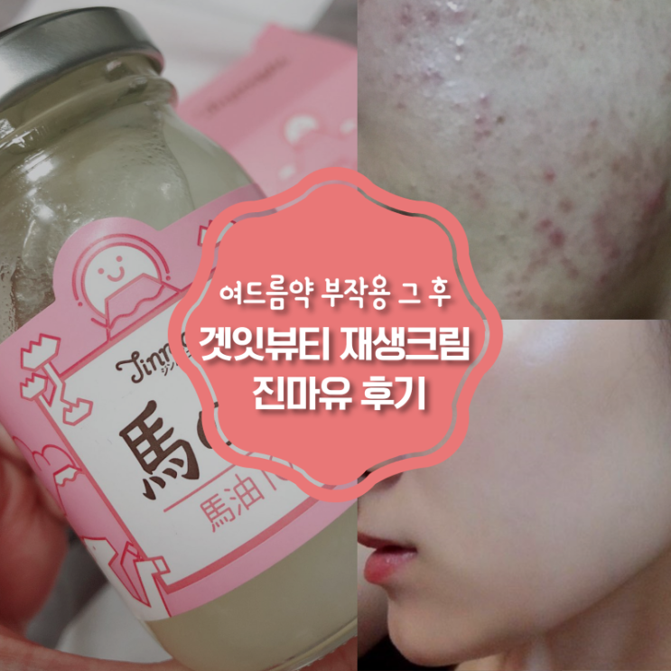  겟잇뷰티 재생크림 순위 여드름약 부작용 그 후