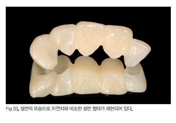 [디지털임상] PMMA Milling을 이용한 임플란트 Provisional bridge 제작⑵ : 네이버 블로그