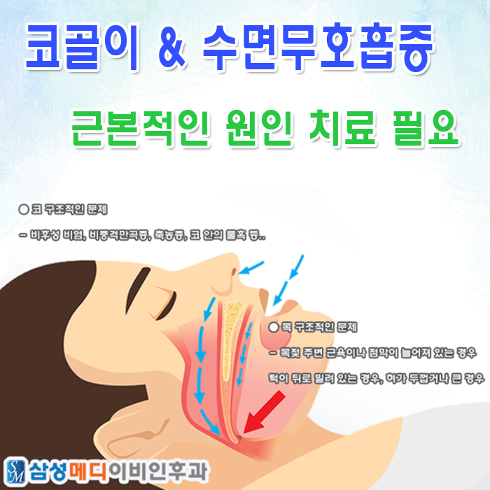 부산코골이수술이 필요한 경우는