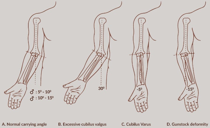 gun stock deformity(cubitus varus) : 네이버 블로그