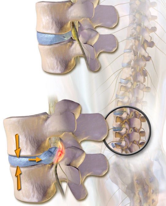 herniated intervertebral disc(HIVD, 추간판탈출증) : 네이버 블로그